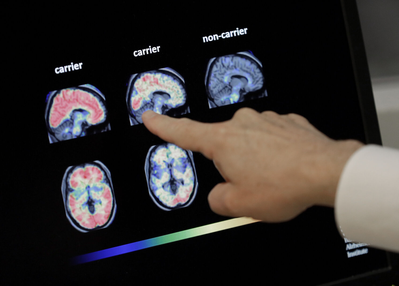 Medicare Alzheimer Brain Scans